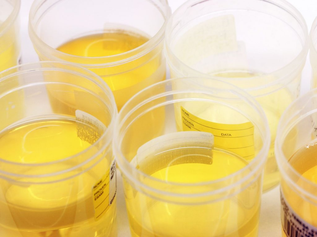 Is Bright Yellow Urine A Sign Of Pregnancy