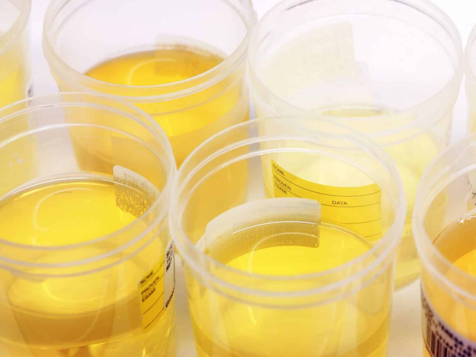 Is Bright Yellow Urine A Sign Of Pregnancy 