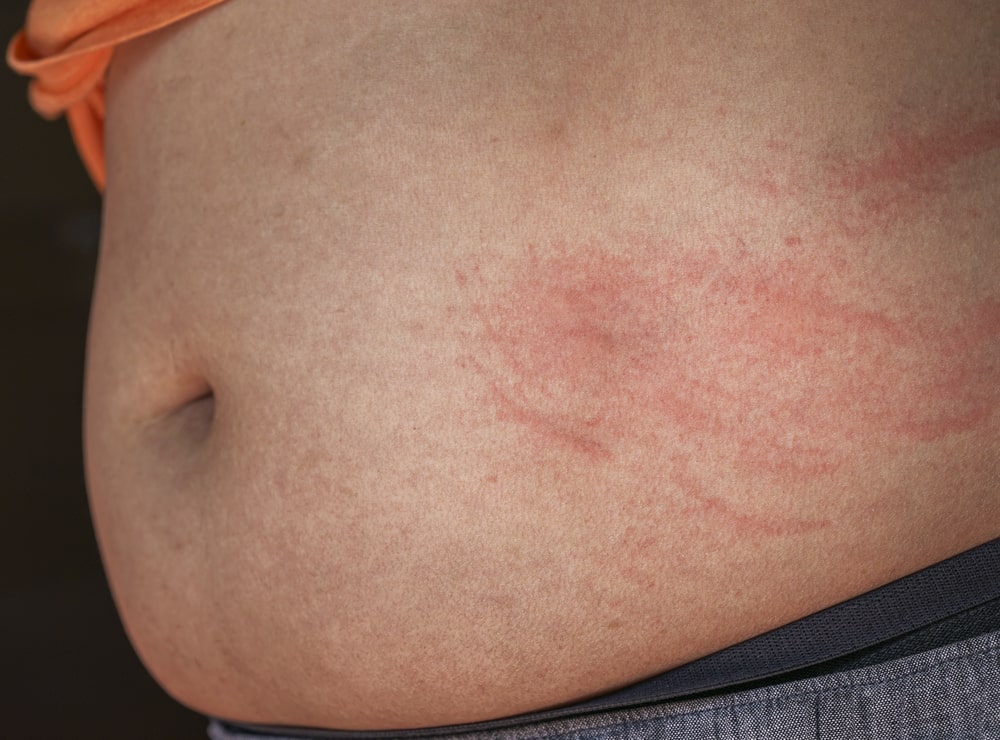 Why Do I Have A Rash On My Stomach And Chest Printable Online