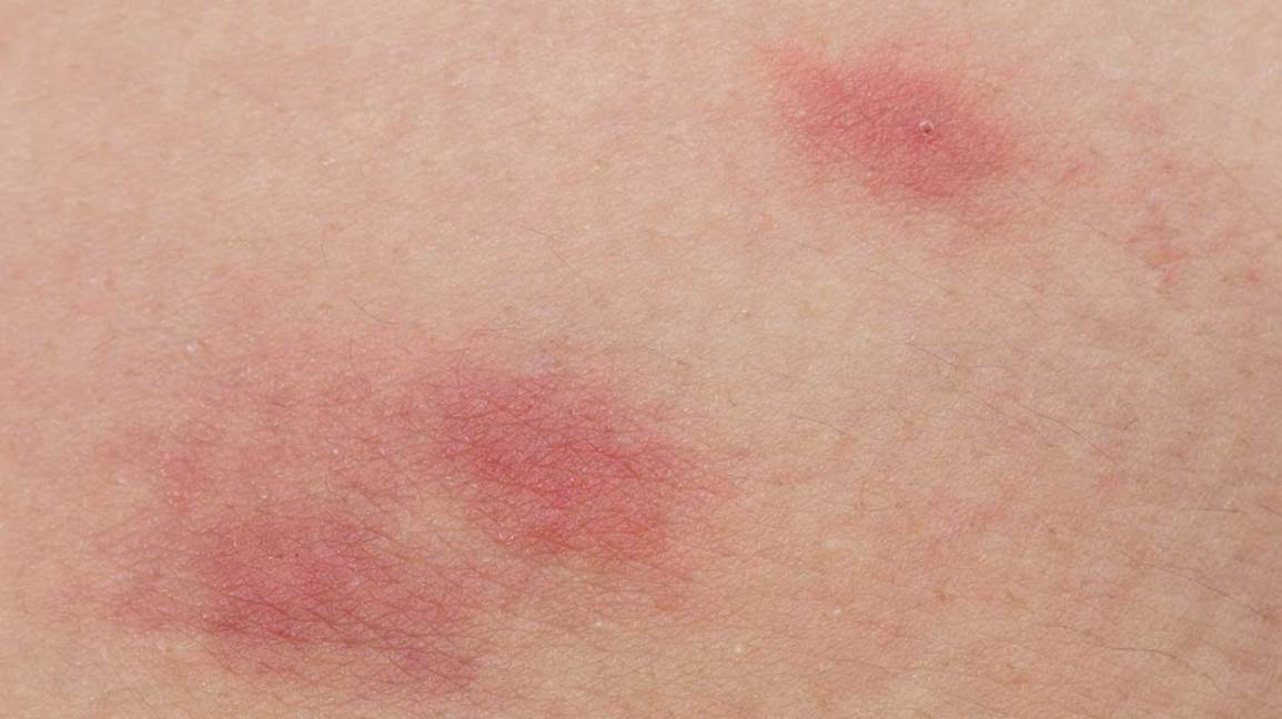 Why Do I Have A Rash On My Stomach After A C Section Why Do I Have A Rash On My Stomach After A C Section