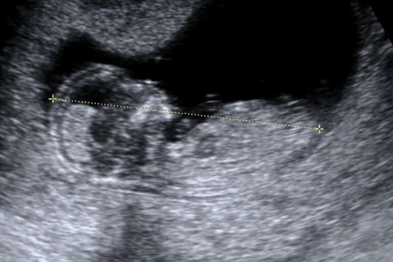 Does A Baby Fetus Have Gills In The Womb?